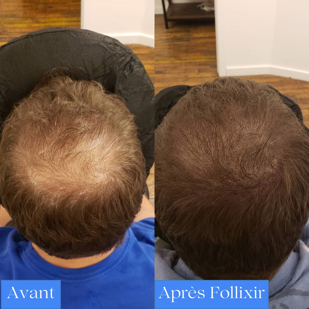Micro-infusion Follixir